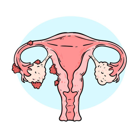 endometriosis-fiv Endometriosis y FIV